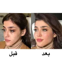 آموزش و خدمات ژل فیلر بوتاکس هایفو توسط پزشک مجرب|خدمات آرایشگری و زیبایی|شهریار, |دیوار