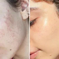 فیشال پاکسازی اسیدتراپی پلاسما خال برداری پلاژن|خدمات آرایشگری و زیبایی|قدس, شهر‌قدس|دیوار