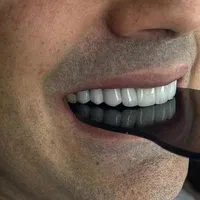 جشنواره کامپوزیت دندان|خدمات آرایشگری و زیبایی|فردیس, فردیس|دیوار