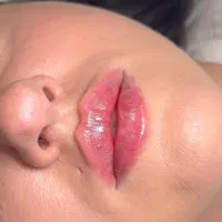 ژل لب و صورت بوتاکس|خدمات آرایشگری و زیبایی|رشت, گلسار|دیوار