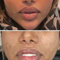 تزریق فیلر و بوتاکس تخصصی
