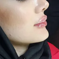 هایفوتراپی لیفت صورت رفع غبغب|خدمات آرایشگری و زیبایی|تهران, میرداماد|دیوار