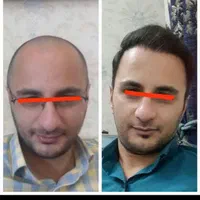 کاشت مو پرتراکم اقساطی با پرداخت 4میلیون تومان|خدمات آرایشگری و زیبایی|اصفهان, میرعماد|دیوار