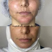 جراح پلک بلفارو ژل چربی صورت ساکشن شکم بوتاکس لیزر|خدمات آرایشگری و زیبایی|یزد, |دیوار