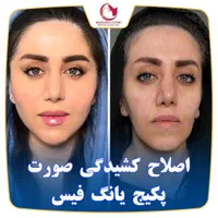 یانگ فیس صورت Noa بینی ابرو غبغب سینه باسن شکم پلک|خدمات آرایشگری و زیبایی|مشهد, هفت تیر (حافظ)|دیوار