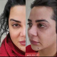 زیبایی صورت با جدید ترین دستگاه هایفو ببینید