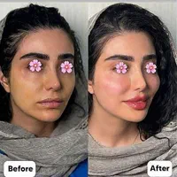 جشنواره بهاره ژل و بوتاکس آنزیم لیزر مزوتوسط پزشک|خدمات آرایشگری و زیبایی|کرج, جهان‌شهر|دیوار