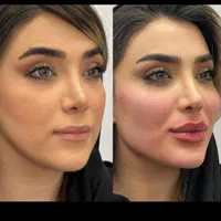 فیلر بیکینی ، لابیا پلاستی ترانسفر باسن بایوفیلر|خدمات آرایشگری و زیبایی|اندیشه, اندیشه فاز ۱|دیوار