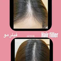 تزریق ژل بوتاکس لیزرمو مزو فیلرلب روسی لیفت صورت|خدمات آرایشگری و زیبایی|تهران, پونک|دیوار