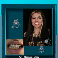 دندانپزشکی ترمیم دندان با مواد کامپوزیت دندان|خدمات آرایشگری و زیبایی|شیراز, معالی‌آباد|دیوار