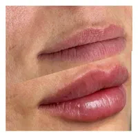 تزریق ژل بوتاکس فیلر مزو و...