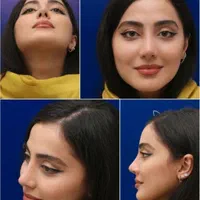 عمل بینی اف ۳روزه