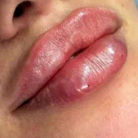 تزیق فیلروبوتاکس لیزر موهای زائد هایفو خالبرداری