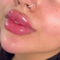 ژل و بوتاکس و مزو سر و صورت|خدمات آرایشگری و زیبایی|کوهدشت, |دیوار