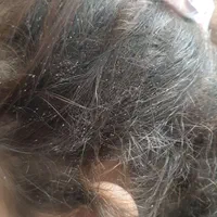 درمان صددرصدگیاهی رشک وشپش|خدمات آرایشگری و زیبایی|گرگان, |دیوار