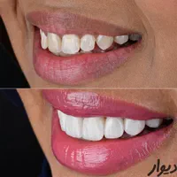 دندانپزشکی کامپوزیت و لمینت تخصصی،کامپوزیت دندان|خدمات آرایشگری و زیبایی|شیراز, عفیف‌آباد|دیوار