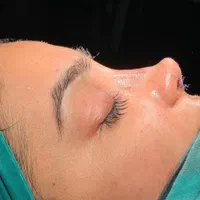 خدمات عمل جراحی زیبایی بینی و ترمیم بینی
