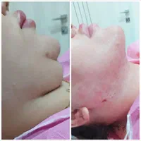 جراحی بینی ابدو،چربی لیپو 360ترانسفر بوتاکس ژل