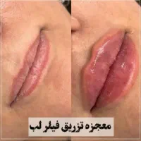 ژل وبوتاکس فیلرلب گونه چانه زاویه فقط ۳۵۰ هزار|خدمات آرایشگری و زیبایی|قم, سالاریه|دیوار