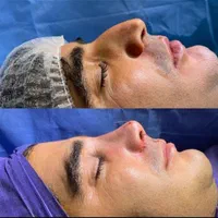 جراحی بینی ابدو،چربی لیپو 360ترانسفر باسن بیکینی|خدمات آرایشگری و زیبایی|اندیشه, اندیشه فاز ۱|دیوار