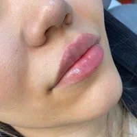 ژل،بوتاکس،مزوتراپی،پی ار پی