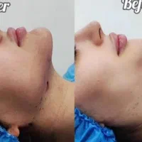 تزریق چربی|خدمات آرایشگری و زیبایی|کرمانشاه, |دیوار