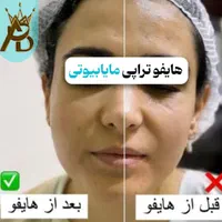 جوانسازی قوی  لیفت صورت ،روشن کننده هایفوتراپی|خدمات آرایشگری و زیبایی|یاسوج, |دیوار