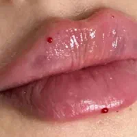 بوتاکس، ژل، چربی، لیزر، هایفوتراپی توسط پزشک|خدمات آرایشگری و زیبایی|یزد, |دیوار