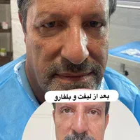 بلفاروپلاستی/ ژل/بوتاکس/هایفو