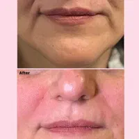 آموزش و انجام خدمات زیبایی ژل، بوتاکس ، آنزیم.مزو|خدمات آرایشگری و زیبایی|بروجرد, |دیوار