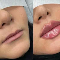 تزریق ژل و بوتاکس و کانتور صورت توسط پزشک|خدمات آرایشگری و زیبایی|فردیس, فردیس|دیوار