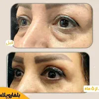 (شوش، شوشتر، اندیمشک) بلفاروپلاستی|خدمات آرایشگری و زیبایی|شوش, |دیوار