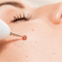 خالبرداری بدون جراحی در کلینیک زیبایی و لیزر راویس|خدمات آرایشگری و زیبایی|کاشان, رجایی|دیوار