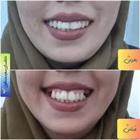 دندان مصنوعی/ دندانسازی ضمانتی/بیش ازنیم قرن تجربه|خدمات آرایشگری و زیبایی|مشهد, کوشش|دیوار