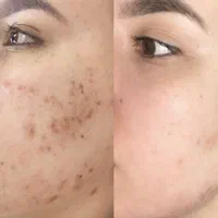 فیشیال تخصصی پوست|خدمات آرایشگری و زیبایی|سبزوار, فرهنگیان|دیوار