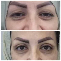 عمل جراحی پلک (بلفاروپلاستی)|خدمات آرایشگری و زیبایی|اصفهان, مسجد مصلی|دیوار