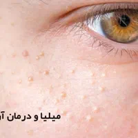 برداشتن خال زگیل میخچه باقیمت فوق العاده توسط پزشک|خدمات آرایشگری و زیبایی|اسلام‌شهر, |دیوار