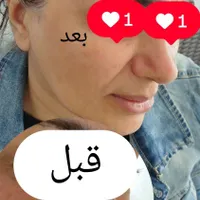 فیشیال تخصصی پوست|خدمات آرایشگری و زیبایی|گلبهار, |دیوار