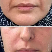 تخفیف تزریق ژل،ژل لب روسی تخصصی،بوتاکس|خدمات آرایشگری و زیبایی|اسلام‌شهر, شهرک انبیا|دیوار