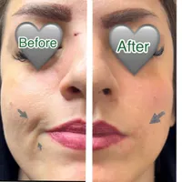 مطب تخفیف ژل و فیلر لب و صورت و بوتاکس|خدمات آرایشگری و زیبایی|قم, صفائیه|دیوار