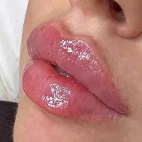 تزریق ژل لب زاویه سازی لیزر بوتاکس۱۰۰ درصد تضمینی|خدمات آرایشگری و زیبایی|تهران, ستارخان|دیوار