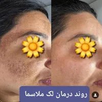 درمان تخصصی کک و مک ،خال،لک و روشن کردن پوست|خدمات آرایشگری و زیبایی|اصفهان, احمدآباد|دیوار