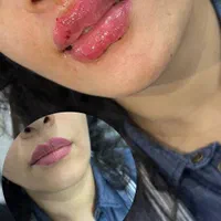 کلینیک تزریق ژل و بوتاکس انزیم پزشک|خدمات آرایشگری و زیبایی|کرج, گوهردشت|دیوار