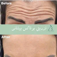 جشنواره هایفوتراپی،ژل، بوتاکس،لیزر در کلینیک پزشکی|خدمات آرایشگری و زیبایی|رشت, معلم|دیوار