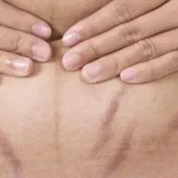 برداشت خال،اسکین تگ،زگیل،کک ومک واسترج مارک|خدمات آرایشگری و زیبایی|شاهین‌شهر, فیض|دیوار