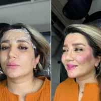 لیفت صورت با نخ. ژل.بوتاکس.مزوژل. درکلینیک|خدمات آرایشگری و زیبایی|کرمانشاه, |دیوار