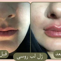 جشنواره بوتاکس،فیلر،‌لب روسی،جوانسازی،توسط پزشک|خدمات آرایشگری و زیبایی|زنجان, |دیوار