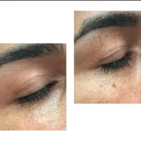خال برداری باقطره گیاهی
