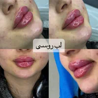 کلینیک تزریق ژل و بوتاکس انزیم پزشک