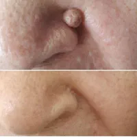 حذف خال ،میخچه ،زگیل فقط بامحلول گیاهی|خدمات آرایشگری و زیبایی|خمینیشهر, |دیوار